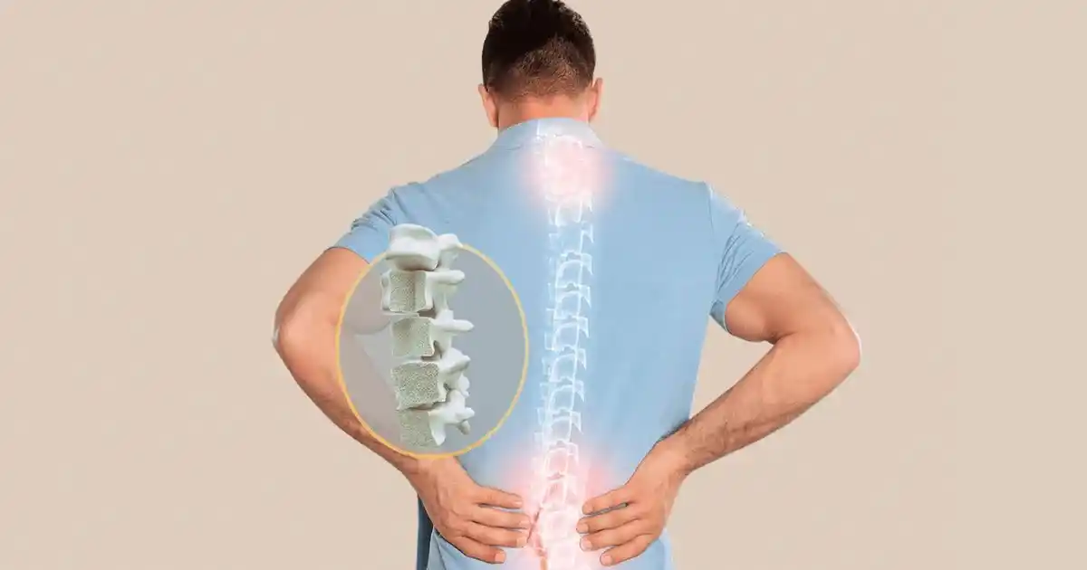 Calcium Deficiency Raises Osteoporosis Risk in Indonesia